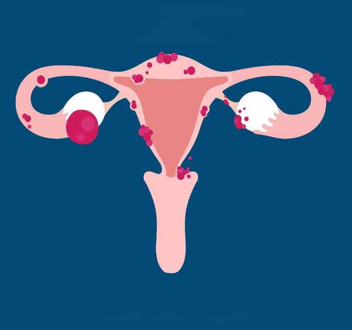 Le rôle de l’urologue dans le cadre de l’endométriose