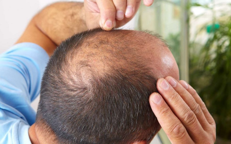 Alopécie chez l’homme : causes et impact psychologique - De Nobis