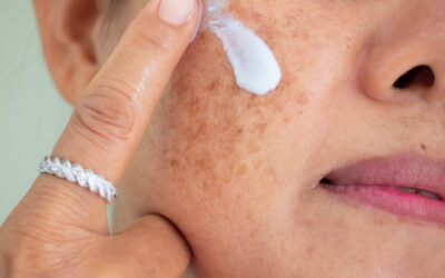 Taches brunes : tout savoir sur cet ennemi silencieux de votre peau